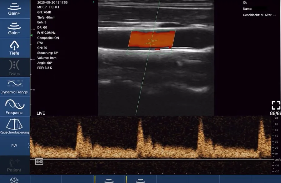 PW-Doppler in der ATLAS-App